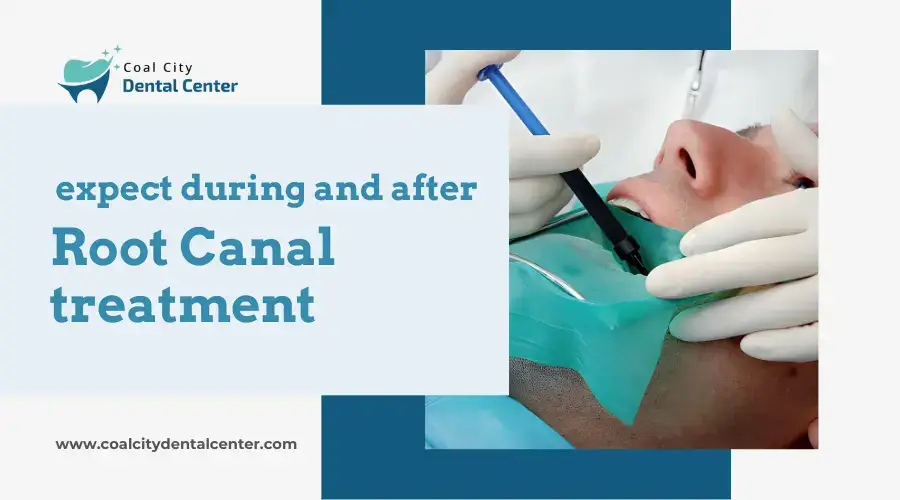 Read more about the article Is a Root Canal painful? What should you expect during and after the procedure?